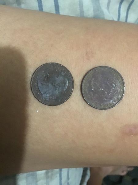 Discoloration